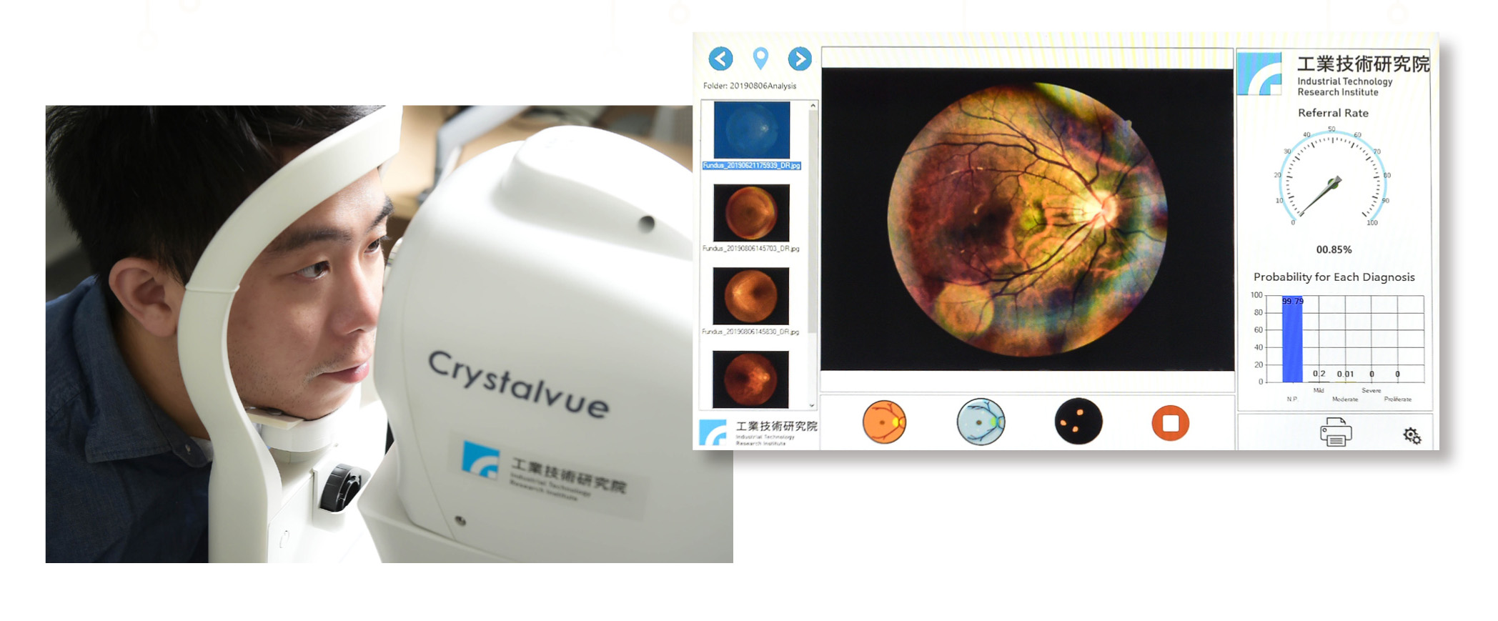 工研院團隊向醫療機構搜集了上百萬張眼底攝影照片，交由專業醫生審圖註記判斷，可將每張眼底攝影照片標示為4個不同的病況等級。