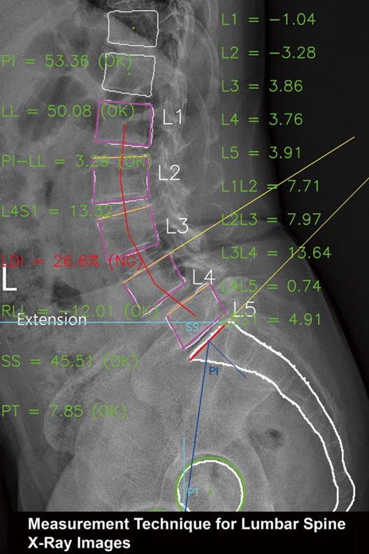 Measurement Technique for Lumbar Spine X-Ray Images.